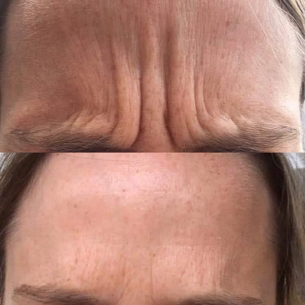 Botox (Forehead & Eyes)