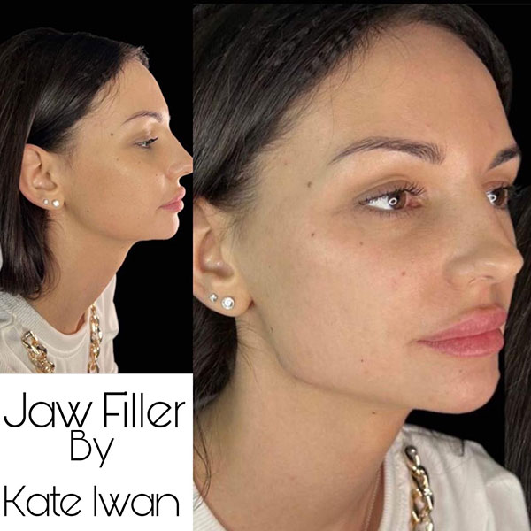Jaw Filler 1ml