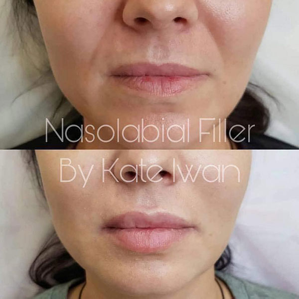 Nasolabial Filler 1ml
