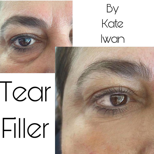 Tear Filler 1ml