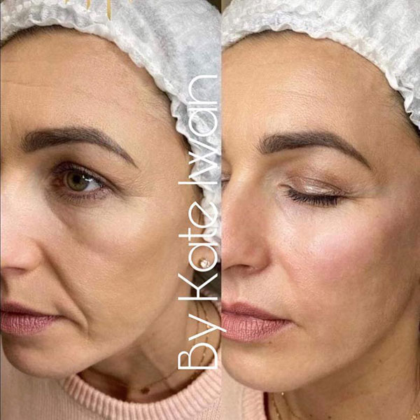 Ejkal40 Skin Booster