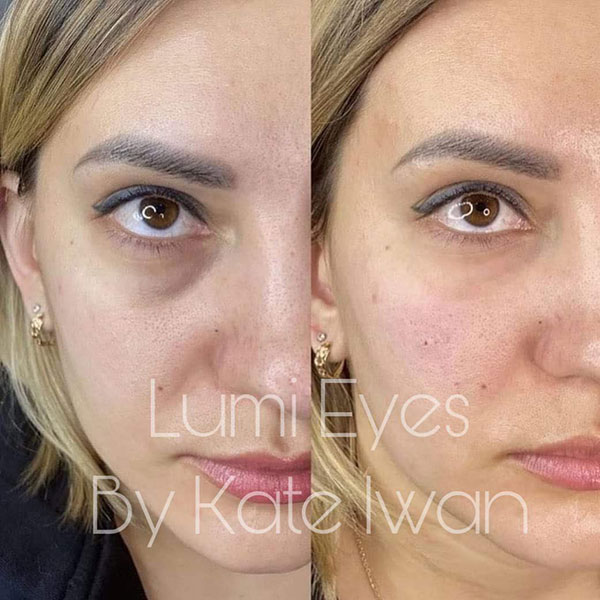 Meso Therapy Lumi Eyes