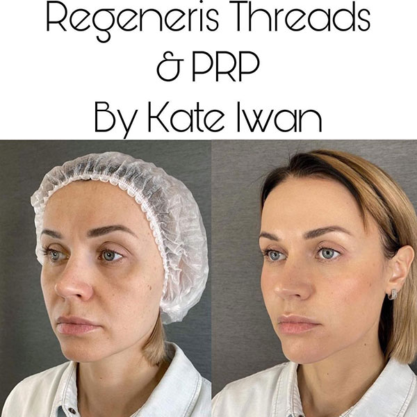 Regeneris Threads & PRP