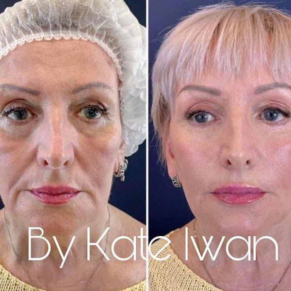 Tissue Stimulating Treatment